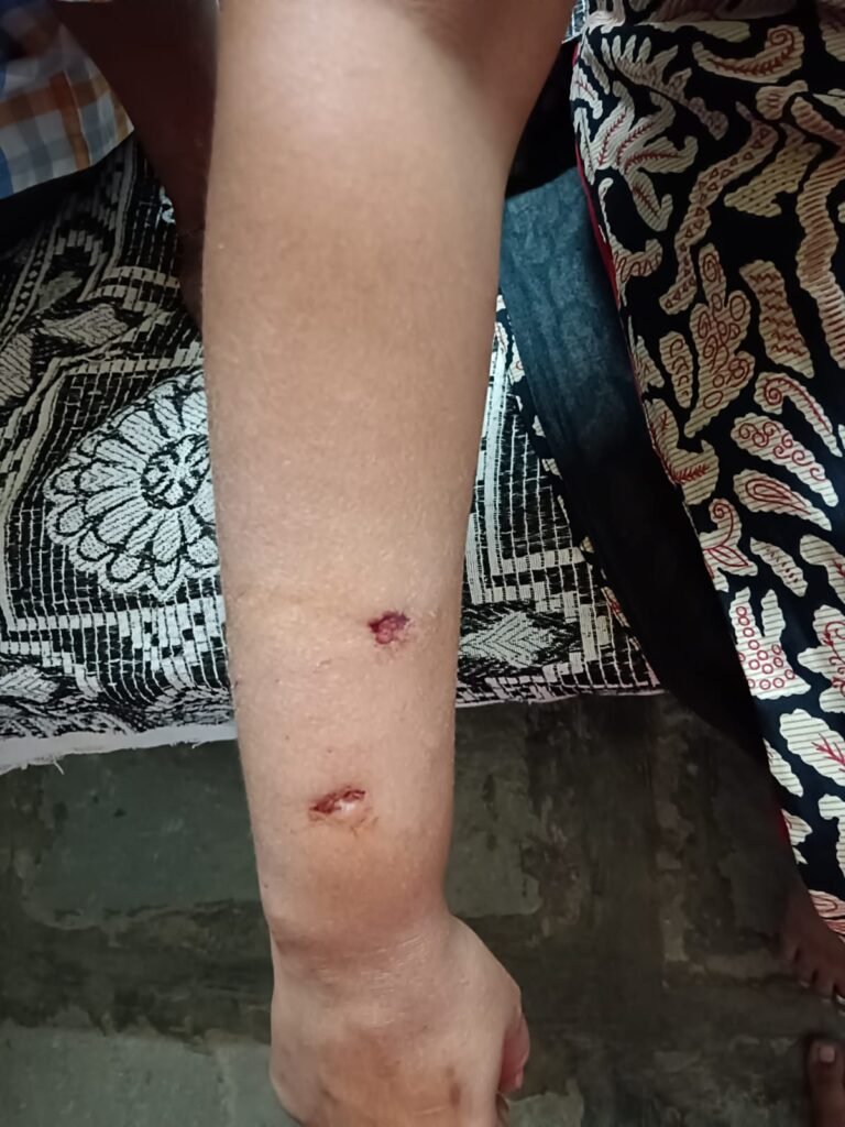 కుక్కల దాడిలో మహిళకు తీవ్ర గాయాలు
