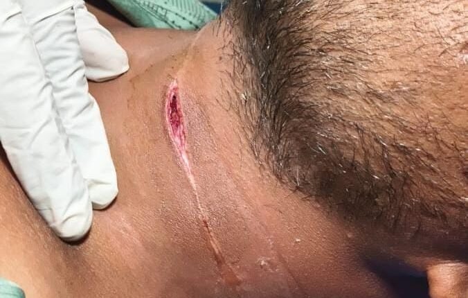 A narrow escape with Chinese manja