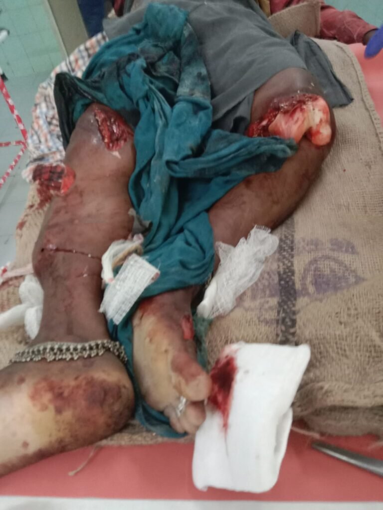Woman seriously injured in Kisan Agro Industries rice mill
