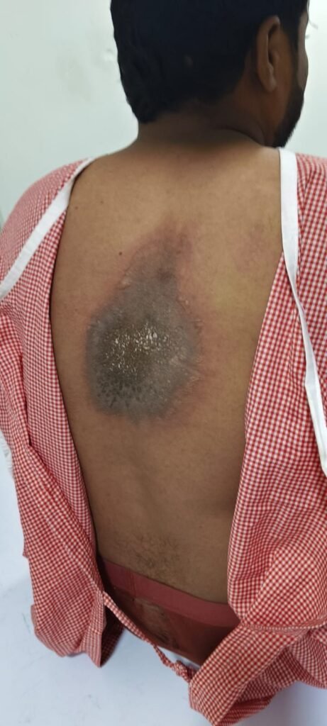Youth sustains severe injuries due to short circuit.