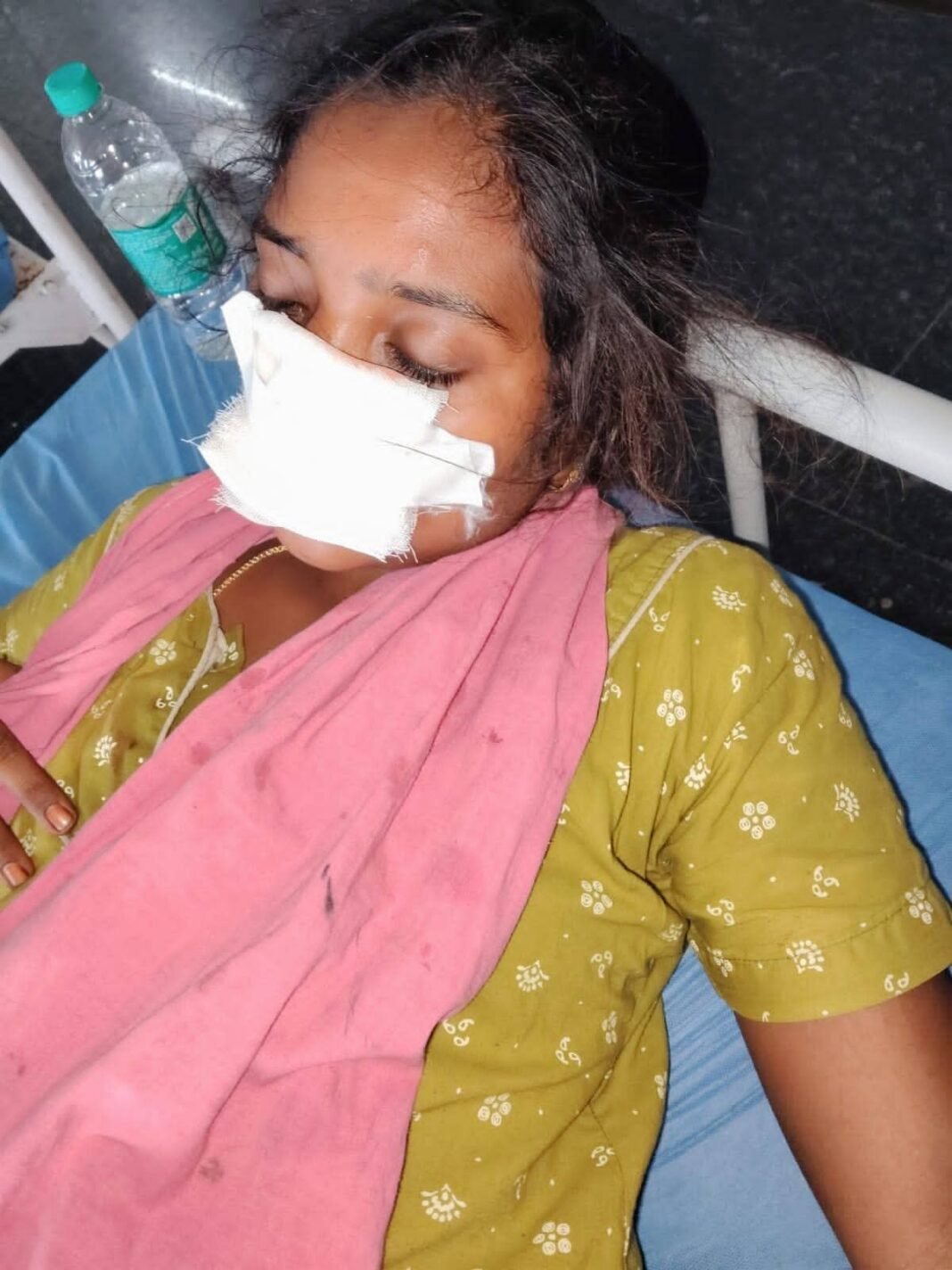 Husband bites off wife's nose