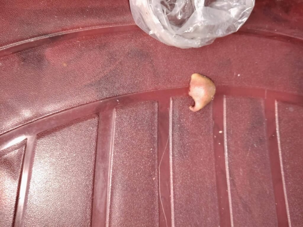 Husband bites off wife's nose